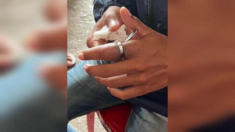 Damkar Kendari Evakuasi Cincin, Jari Pemuda Bengkak dan Luka